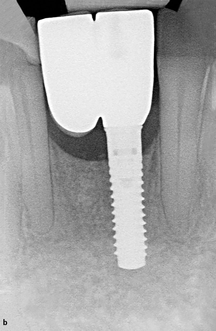 Abb. 3a bis d Klinische (a) und radiologische (b) Situation einer implantatgetragenen Extensionsbrücke in der Unterkieferfront bei einer reduzierten Bezahnung im Seitenzahnbereich zur Vermeidung einer abnehmbaren Versorgung sowie klinische (c) und radio­logische (d) Situation einer implantatgetragenen Extensionsbrücke im Seitenzahnbereich als Alternative zu einer zahngetragenen viergliederigen Brückenversorgung.