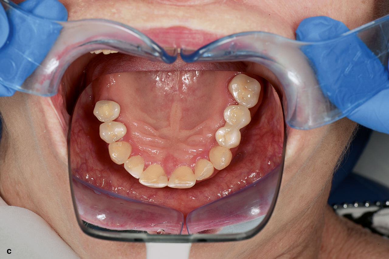 Abb. 3a bis d Klinische (a) und radiologische (b) Situation einer implantatgetragenen Extensionsbrücke in der Unterkieferfront bei einer reduzierten Bezahnung im Seitenzahnbereich zur Vermeidung einer abnehmbaren Versorgung sowie klinische (c) und radio­logische (d) Situation einer implantatgetragenen Extensionsbrücke im Seitenzahnbereich als Alternative zu einer zahngetragenen viergliederigen Brückenversorgung.