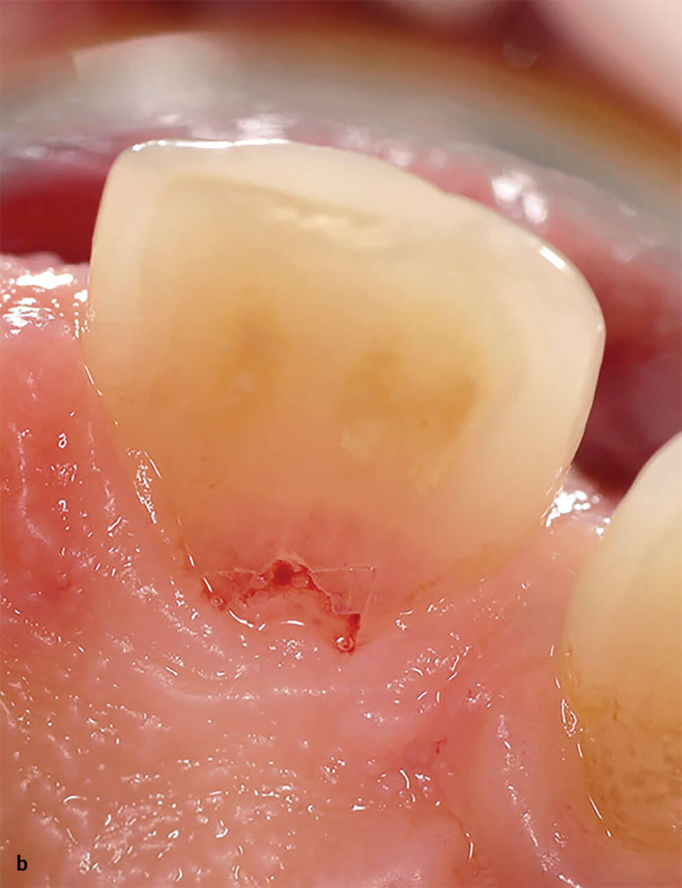 Abb. 2b Rötlich-transluzente Verfärbung mit einer kleinen lokalisierten resorptionsbedingten Perfora-
tion palatinal, zervikal an 
Zahn 11.