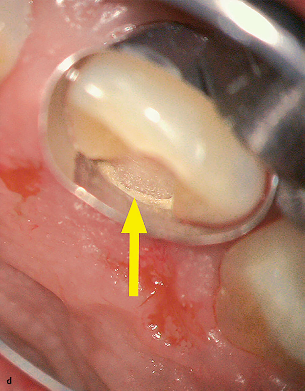 Abb. 2d Palatinalansicht nach Matrizenapplikation und Abdichten des Matrizenrandes mit MTA (s. Pfeil).