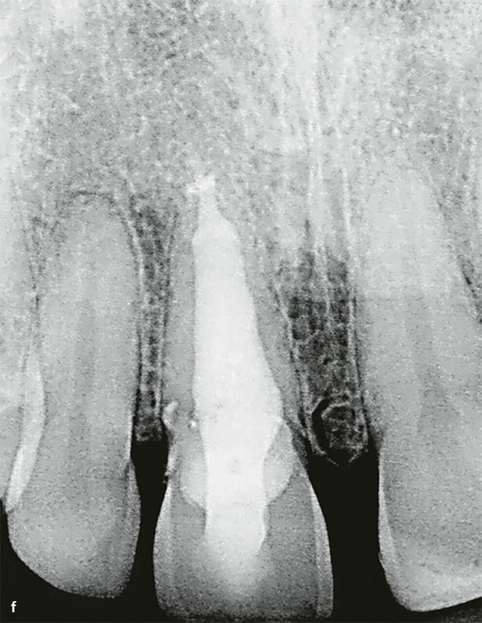 Abb. 2f Postoperative Röntgenaufnahme von Zahn 11 nach der Wurzelkanalfüllung mit apikalem MTA-Plug und Komposit, wobei der leichte apikale Überschuss an Wurzelkanalfüllmaterial MTA ist.