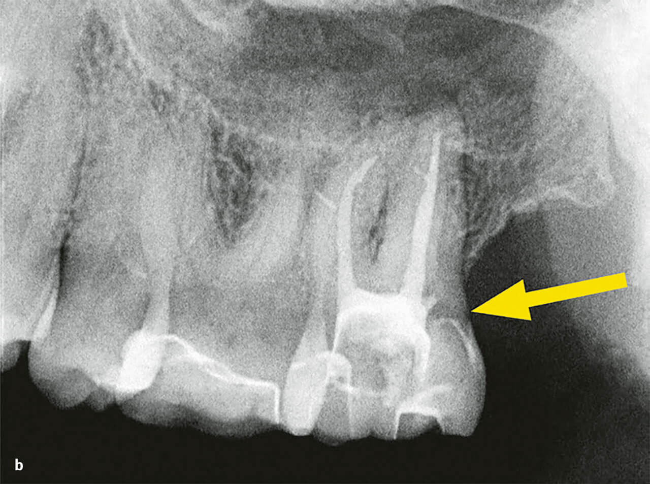 Abb 3b Röntgenbild von Zahn 27, aufgenommen vom überweisenden Zahnarzt nach der Wurzelkanalfüllung. Der Pfeil zeigt auf die Eintrittspforte der IZR, die nicht verschlossen zu sein schein scheint.