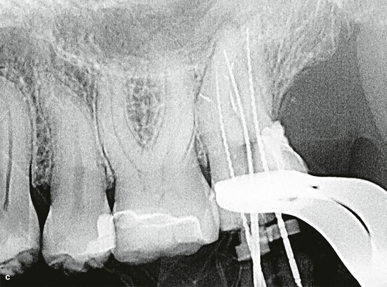 Abb 3c Röntgenmessaufnahme von Zahn 27 nach Verschluss der distalen Perforation.