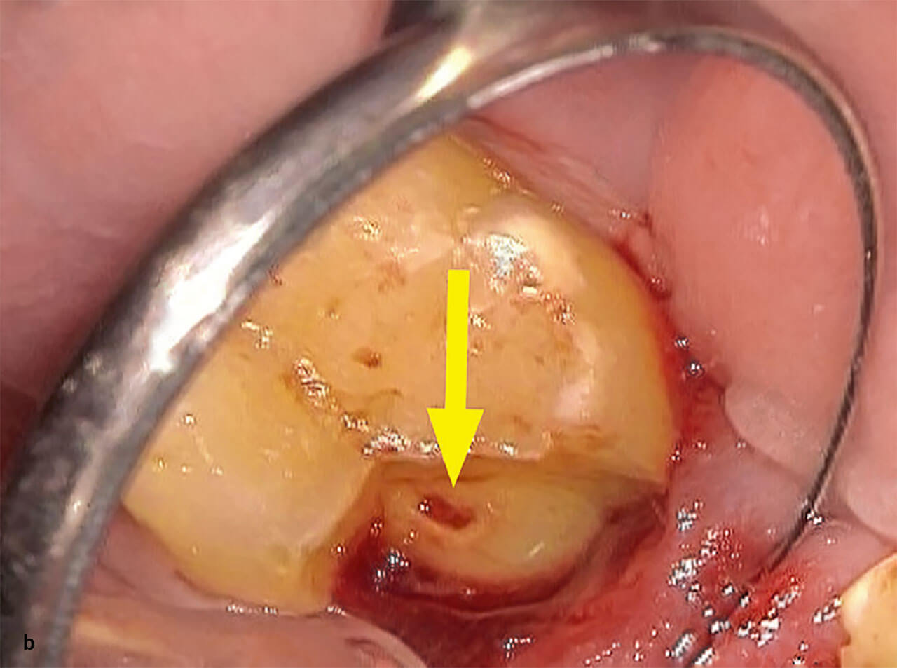 Abb 4b Nach vorsichtiger Entfernung des frakturierten distolingualen Kronenfragments von Zahn 37 wird eine Pulpaeröffnung erkennbar (s. Pfeil).