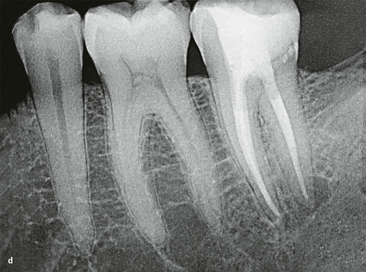 Abb 4d Post­operatives Röntgenbild von Zahn 37.