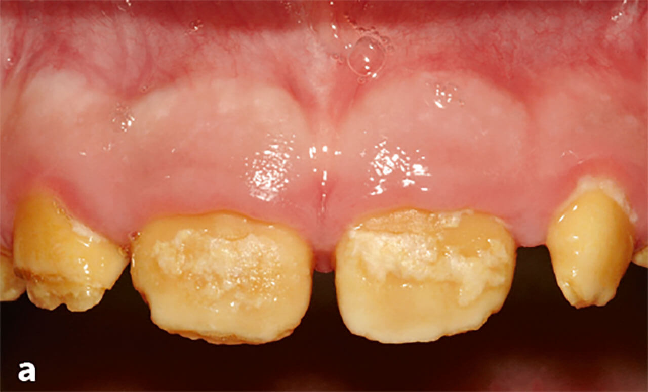 Abb. 1a Unterschiedliche Aus­prägungen einer hypoplastischen AI. Vereinzelte Schmelzinseln sind auf der Labialfläche der bleibenden oberen mittleren Schneidezähne erkennbar.