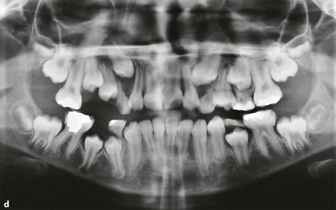 Abb. 2d Das OPG untermauert den klinischen Befund und demonstriert die gleiche Röntgenopazität vom Schmelz und Dentin.