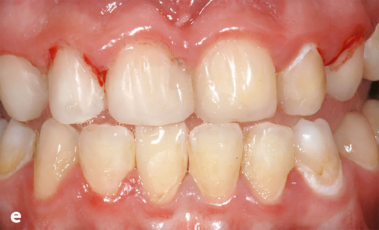 Abb. 2e  Frontalansicht nach Entfernung des hypomaturierten Schmelzes und adhäsiver Restauration aller Frontzähne mit einem Komposit vor Beginn der kieferorthopädischen Behandlung, die nach der Extraktion der ersten Molaren einen orthodontischen Lückenschluss vorsah.