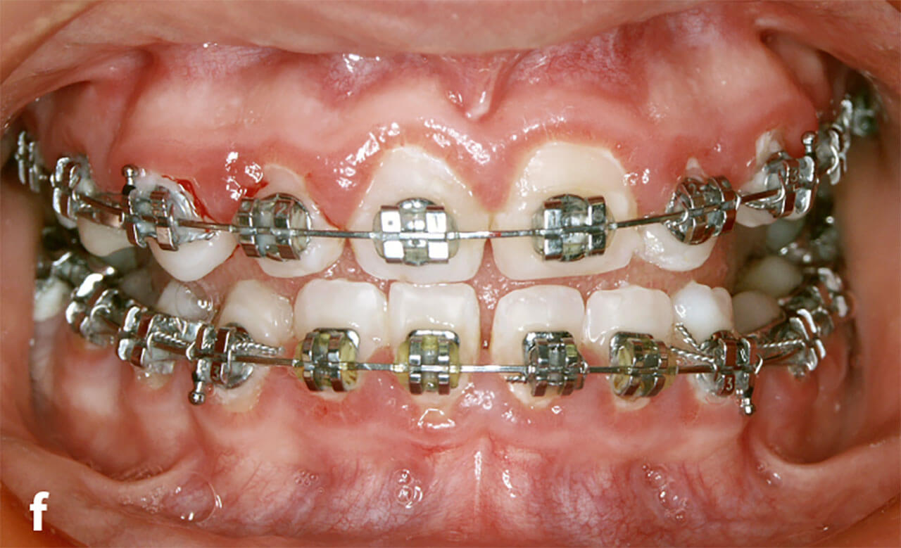 Abb. 2f Frontalansicht nach Eingliederung der festsitzenden kieferorthopädischen Apparatur mit adhäsiver Befestigung der Brackets auf der Kompositoberfläche.