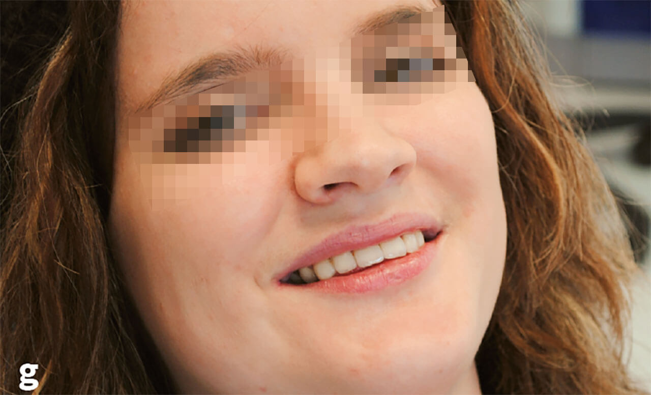 Abb. 2g Auffällig ist die weiterhin bestehende unzureichende Mundhygiene der Patientin und die persistierende Gingivitis. En-face-Ansicht der Patientin nach der Kronenversorgung des Gesamtgebisses im Alter von 18 Jahren.