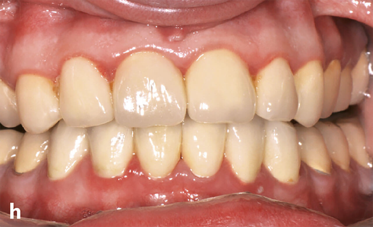 Abb. 2h Frontalansicht nach der Versorgung mit Keramikkronen bei weiterhin persistierender Gingivitis.