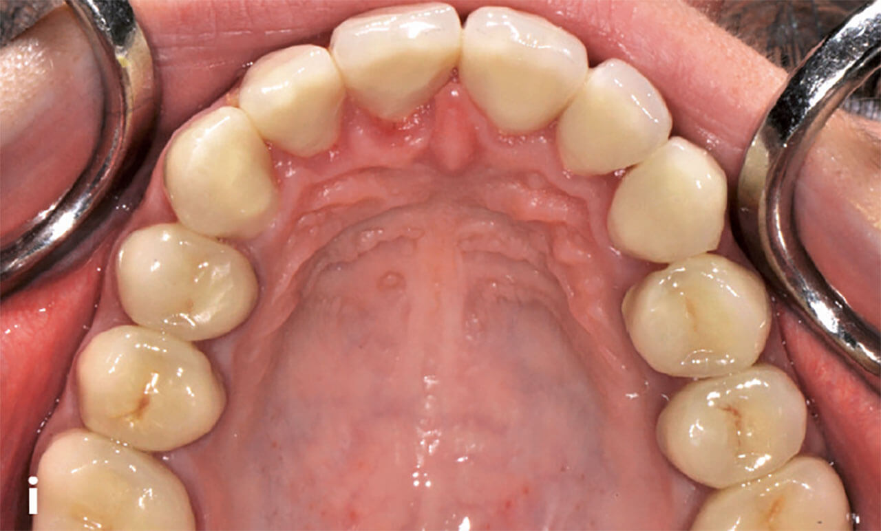Abb. 1i und j Ober- und Unterkieferübersicht nach der Extraktion der ersten bleibenden Molaren und dem orthodontischen Lückenschluss im Rahmen der kieferorthopädischen Therapie sowie der definitiven Versorgung aller Zähne mit Keramikkronen.