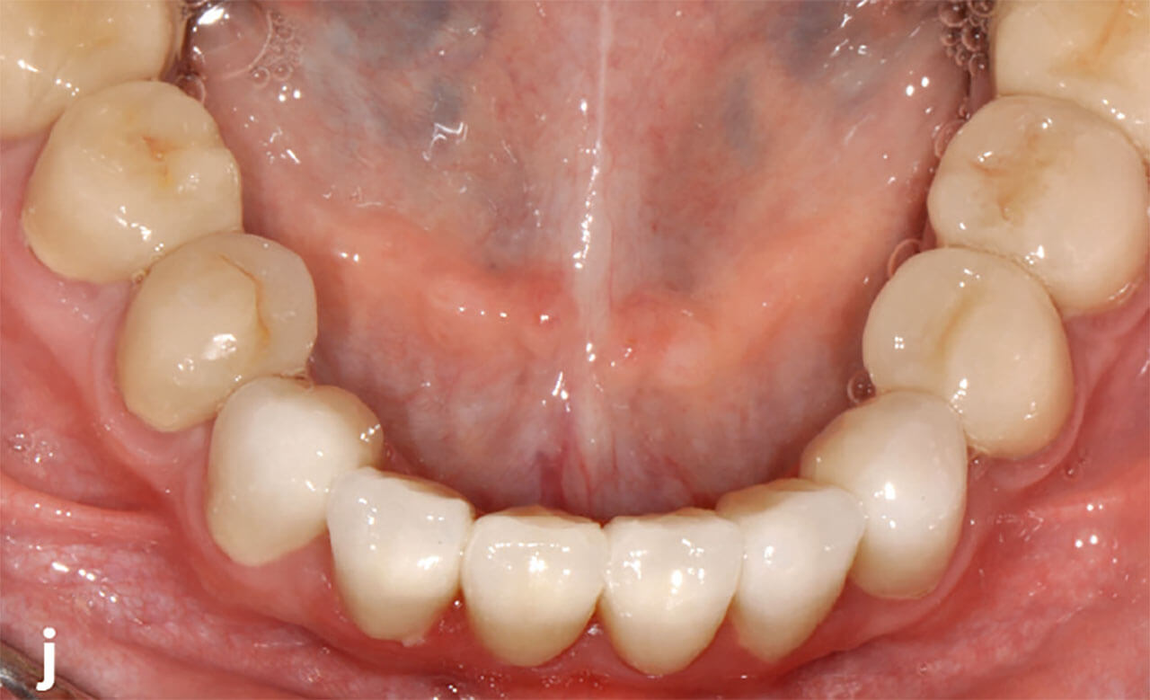 Abb. 1i und j Ober- und Unterkieferübersicht nach der Extraktion der ersten bleibenden Molaren und dem orthodontischen Lückenschluss im Rahmen der kieferorthopädischen Therapie sowie der definitiven Versorgung aller Zähne mit Keramikkronen.