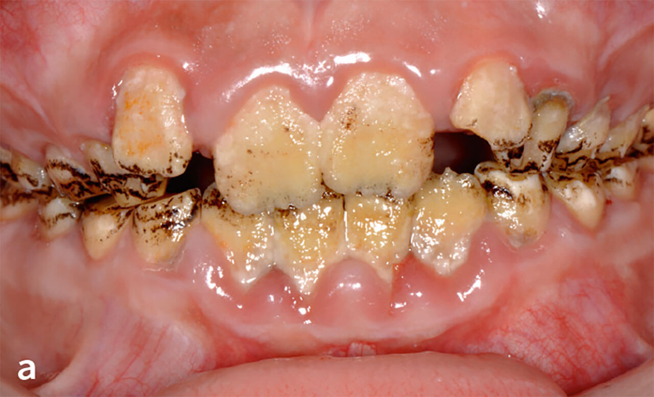 Abb. 3a Hypomineralisierte AI bei einem siebenjährigen Patienten. In der Frontalansicht wird aufgrund der ausgeprägten Biofilmablagerung auf den Frontzähnen und der etablierten Schmutzgingivitis die vor­liegende AI maskiert.