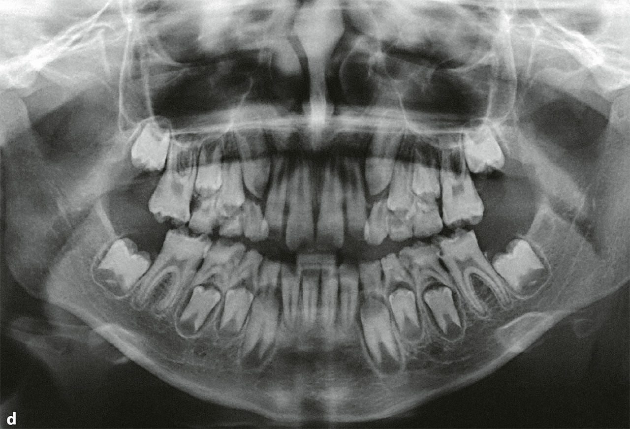 Abb. 3d Das OPG visualisiert bei vergleichbarer Röntgenopazität vom Schmelz und Dentin den klinischen röntgenologischen Befund bei einem altersgerechten Zahnstatus.