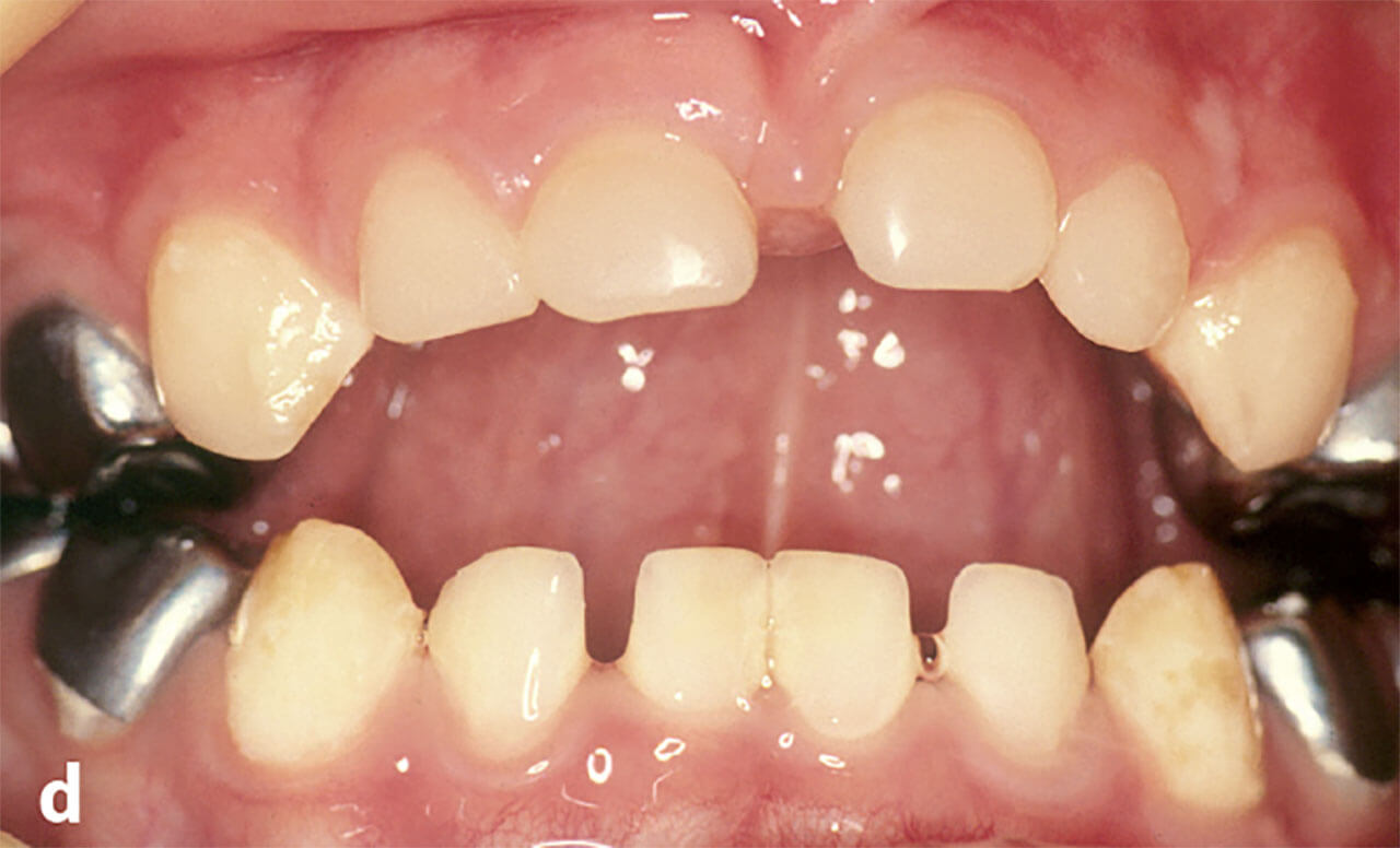 Abb. 4d Frontalansicht nach der adhäsiven Restauration der oberen Milchfront- und Eckzähne mit Komposit und Zahnsteinentfernung an den unteren Schneidezähnen.