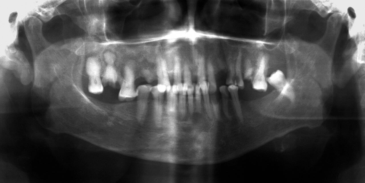 Abb. 1 Panoramaschichtaufnahme (PSA) bei Erstvorstellung der Patientin.