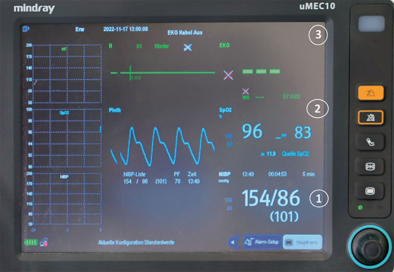 Abb. 2 Überwachungsmonitor uMEC10 (Fa. Mindray Medical Germany, Darmstadt): Blutdruckanzeige (1), Sauerstoffsättigung und Atemintervall (2), EKG-Anzeige (3). Das Set-up des Displays ist bei diesem Gerät individuell einstellbar und hier nur beispielhaft.