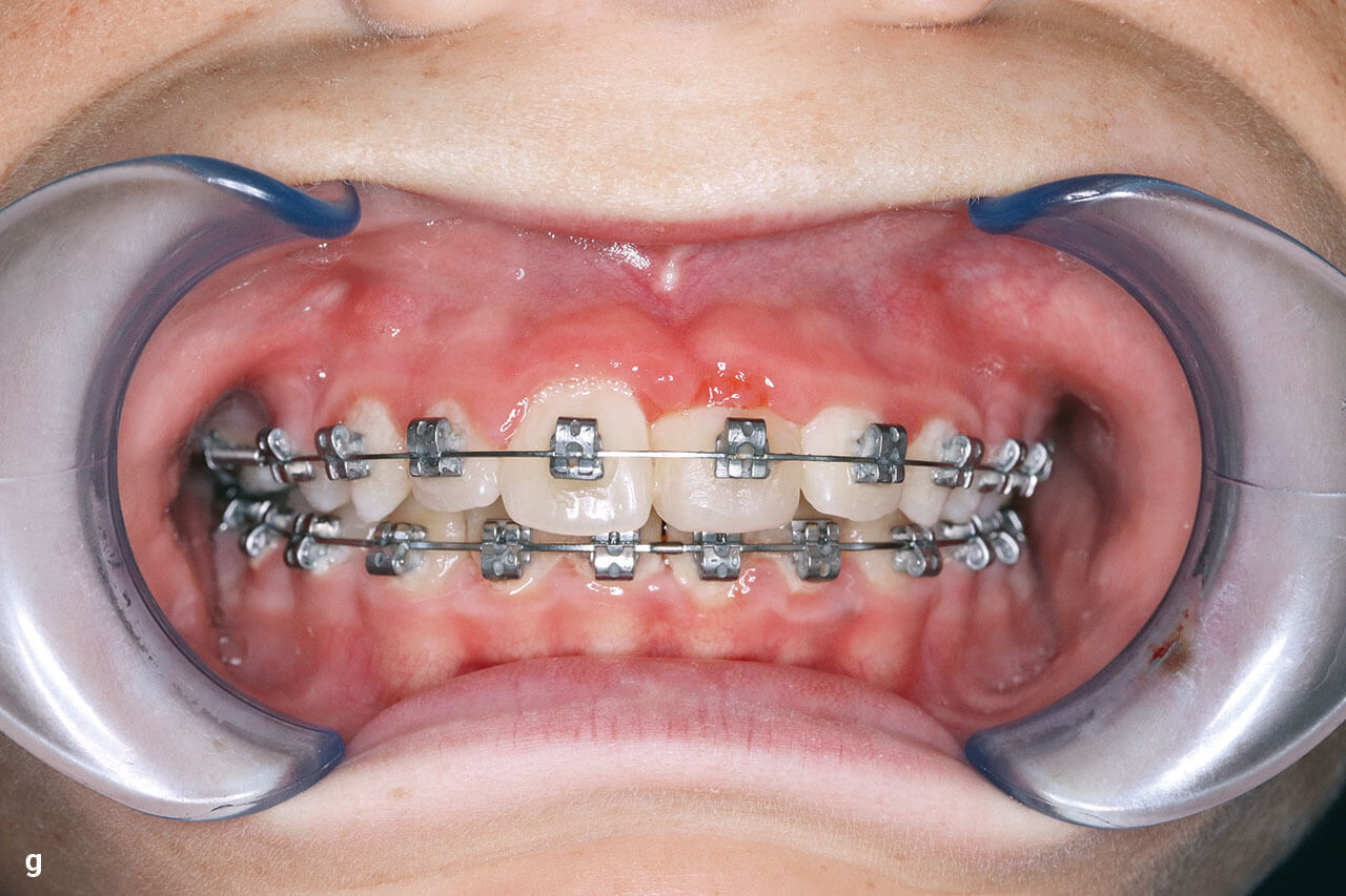 Zu Abb. 1g korrespondierender klinischer Situs nach erstem Ausmodellieren des Prämolarentransplantats in Position 21 zum Frontzahn (g). Suboptimal sind die noch unruhigen hyperplastischen Gingivaverhältnisse, welche wohl in erster Linie mit der verbesserungswürdigen Mundhygiene in Zusammenhang stehen. Auch die Form des Zahns kann – vor allem im Papillenbereich – noch verbessert werden.