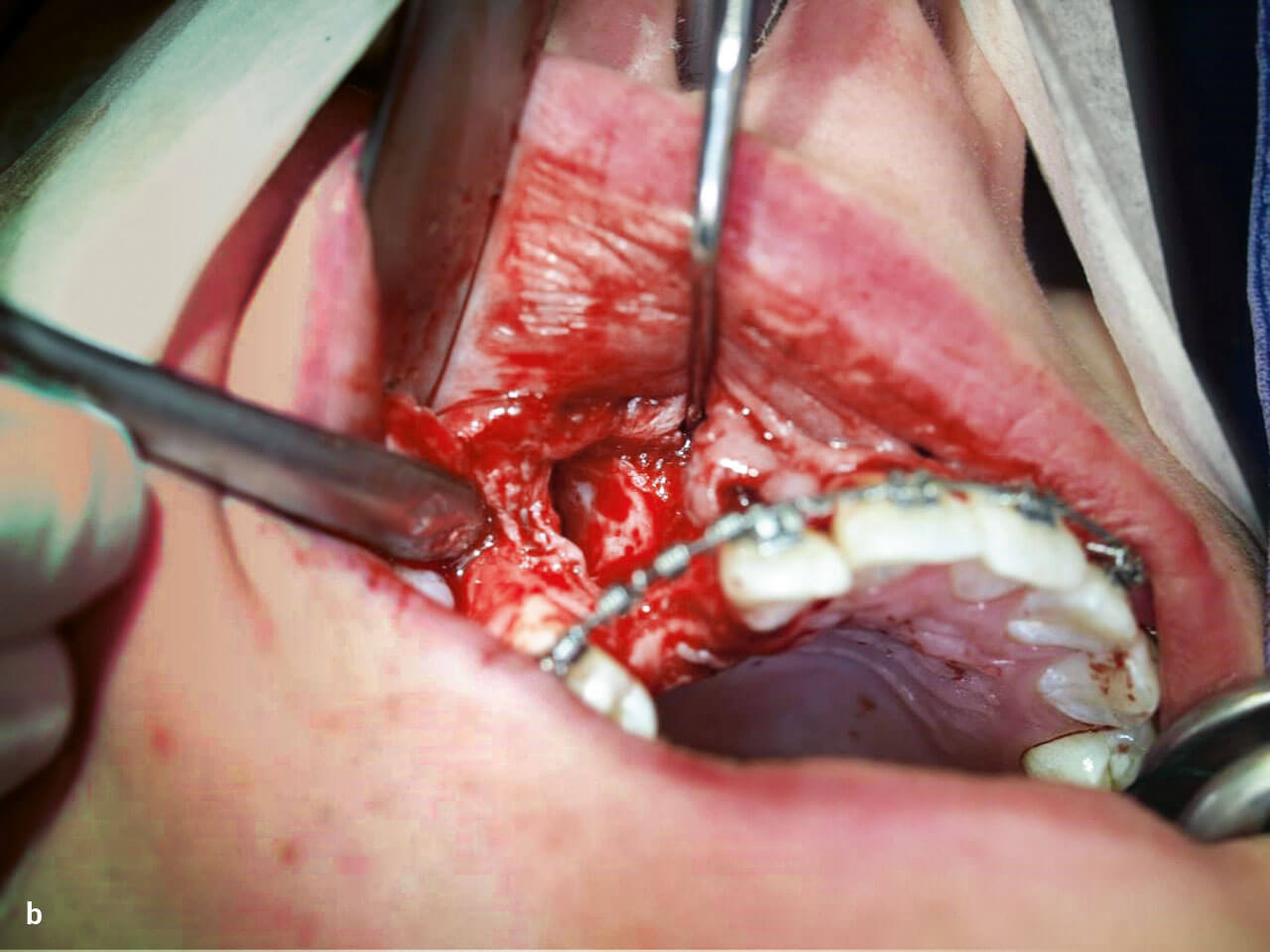 Abb. 4b Entnahme des retinierten Zahns und Bildung einer Neoalveole.