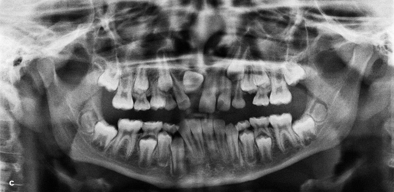 Abb. 1c bis d Einengung der Lücke für den Zahn 11 durch Aufwanderung und Kippung der Nachbarzähne bei Durchbruchsstörung in der Folge eines Traumas im Milchgebiss.