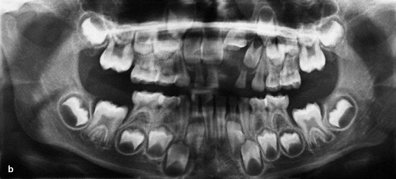 Abb. 5a bis c Ausgangssituation bei einem Patienten mit Durchbruchsstörung an Zahn 21 nach Milchzahntrauma, 
klinisches Bild (a), OPG (b), FRS (c).
