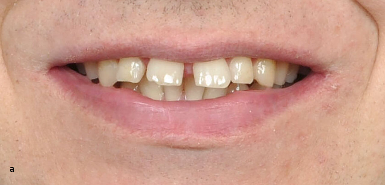 Abb. 5a Lachaufnahmen von zwei erwachsenen Patienten mit Lücken im Bereich der Oberkieferfrontzähne: Lückenbildung aufgrund eines ausgeprägten Labialstands der Oberkieferfrontzähne.