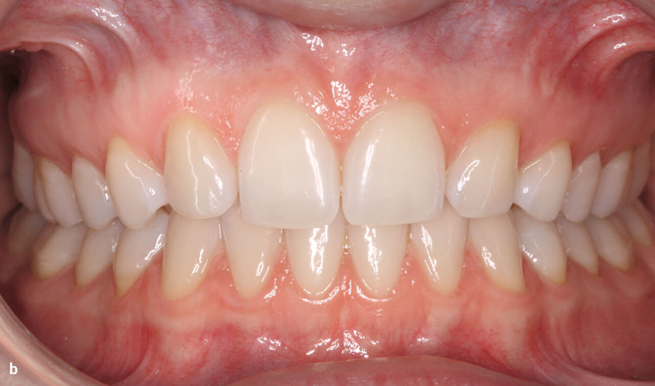 Abb. 3 b In der Frontalansicht der Zähne und Gingiva fällt die Einstellung der Eckzähne anstelle der OK-2er kaum auf. Da sich die OK-3er in jeglicher Hinsicht sehr gut als 2er-Ersatz eigneten, sah die Patientin von der Möglichkeit zur geringfügigen Optimierung mittels kleiner Aufbauten im mesialen Inzisalkantenbereich ab.