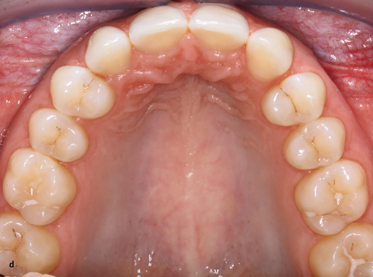 Abb. 3 d In der OK-Aufsichtsaufnahme fällt eine kleine, frontal unsichtbare Lücke distal des Zahns 23 von ca. 0,5 mm auf, die sich in den 3 Jahren seit Beendigung der Retentionsmaßnahmen bildete. Eine mögliche Korrektur mittels Aligner wurde von der Patientin nicht gewünscht.