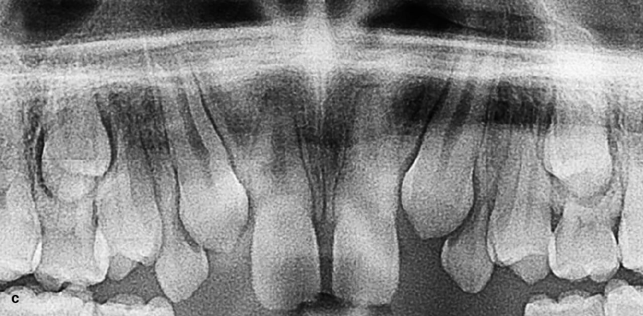 Abb. 4 c Ausschnitt der PSA mit eindeutig verifizierbaren Aplasien der Zähne 12 und 22. Die bleibenden Zähne 13 und 23 brechen direkt distal der mittleren Inzisivi durch.
