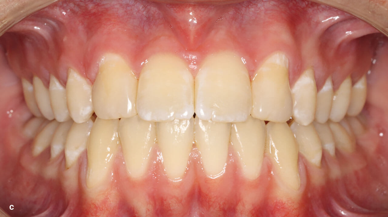 Abb. 6 c Die frontale dentale Ansicht zeigt den ähnlich hohen Gingiaverlauf von mittleren OK-Inzisivi und an 2er-Stelle positionierten Eckzähnen. Ästhetisch günstiger wären ein etwas kaudaler Gingivaverlauf im 3er-Bereich und ein etwas stärkerer kranialer Gingivaverlauf im Bereich der OK-4er. Eine mögliche Gingivektomie an den Zähnen 14 und 24 zervikal zur Verbes­serung der Rot-Weiß-Ästhetik wurde seitens des Patienten jedoch abgelehnt.