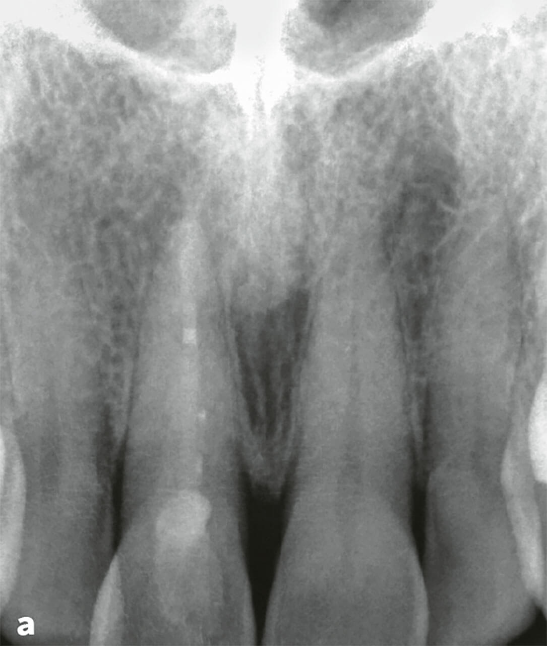 Abb. 13a Am Zahn 11 mit inhomogener Wurzelkanalfüllung und apikaler Aufhellung wird eine Revision erforderlich. Es besteht der Verdacht auf einen tiefen dentinadhäsiven Verschluss mit Komposit.