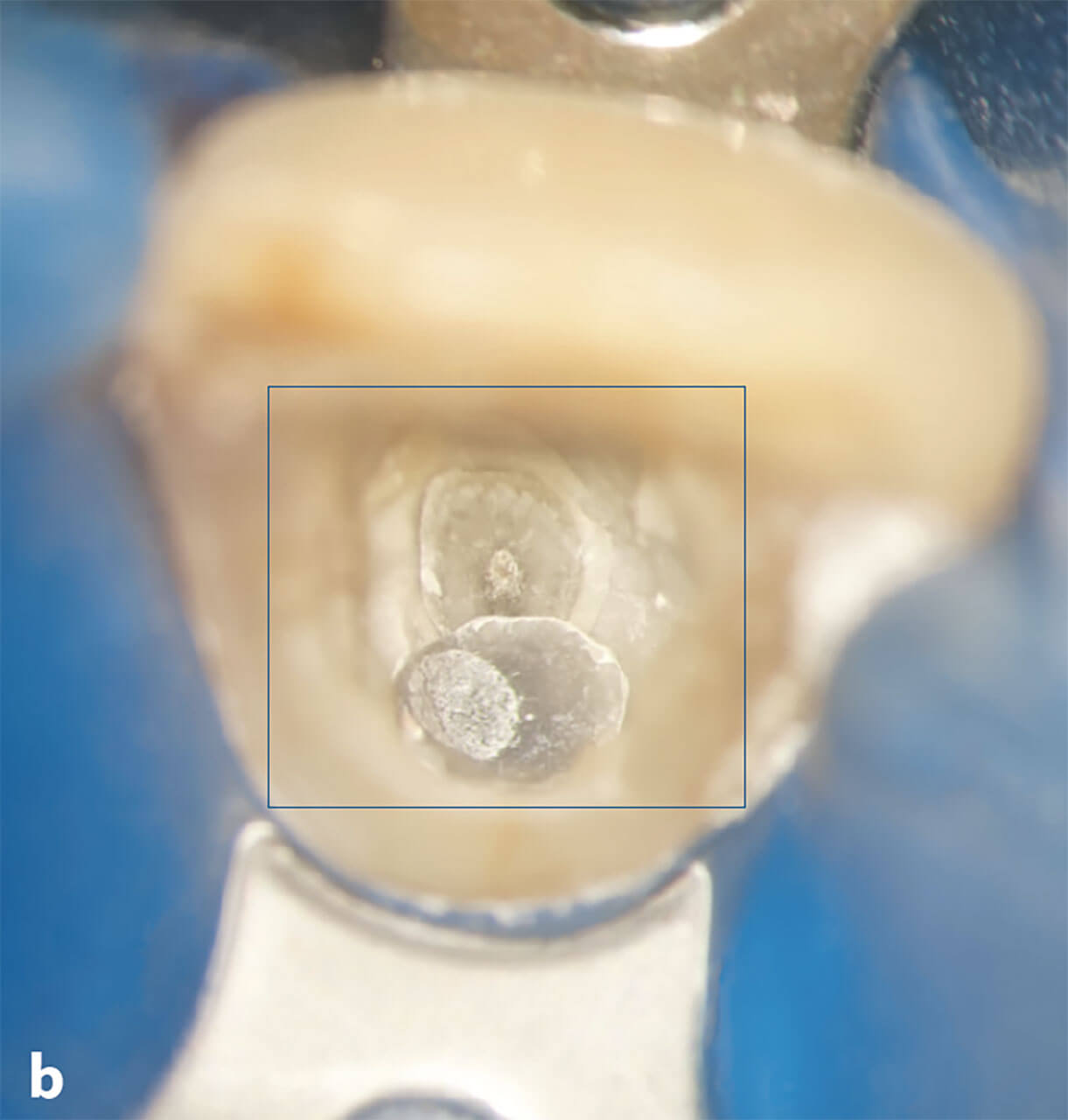 Abb. 13b Sicht in die Zugangskavität am Zahn 11 mit verschiedenen Gewebearten und Füllungsmaterialien.