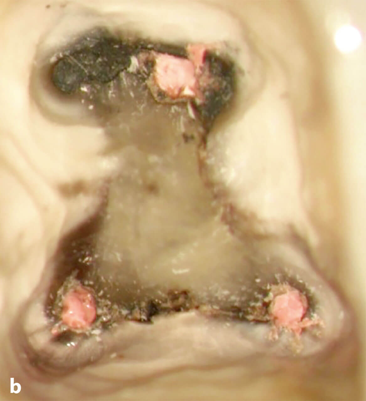 Abb. 17b IKD-Befund: schwarze Infiltration des Dentins von Sealer-Bestandteilen, Isthmus mit nekrotischem Pulpagewebe, drei in Einstifttechnik mit Guttapercha gefüllte Wurzelkanäle ohne Wandständigkeit.