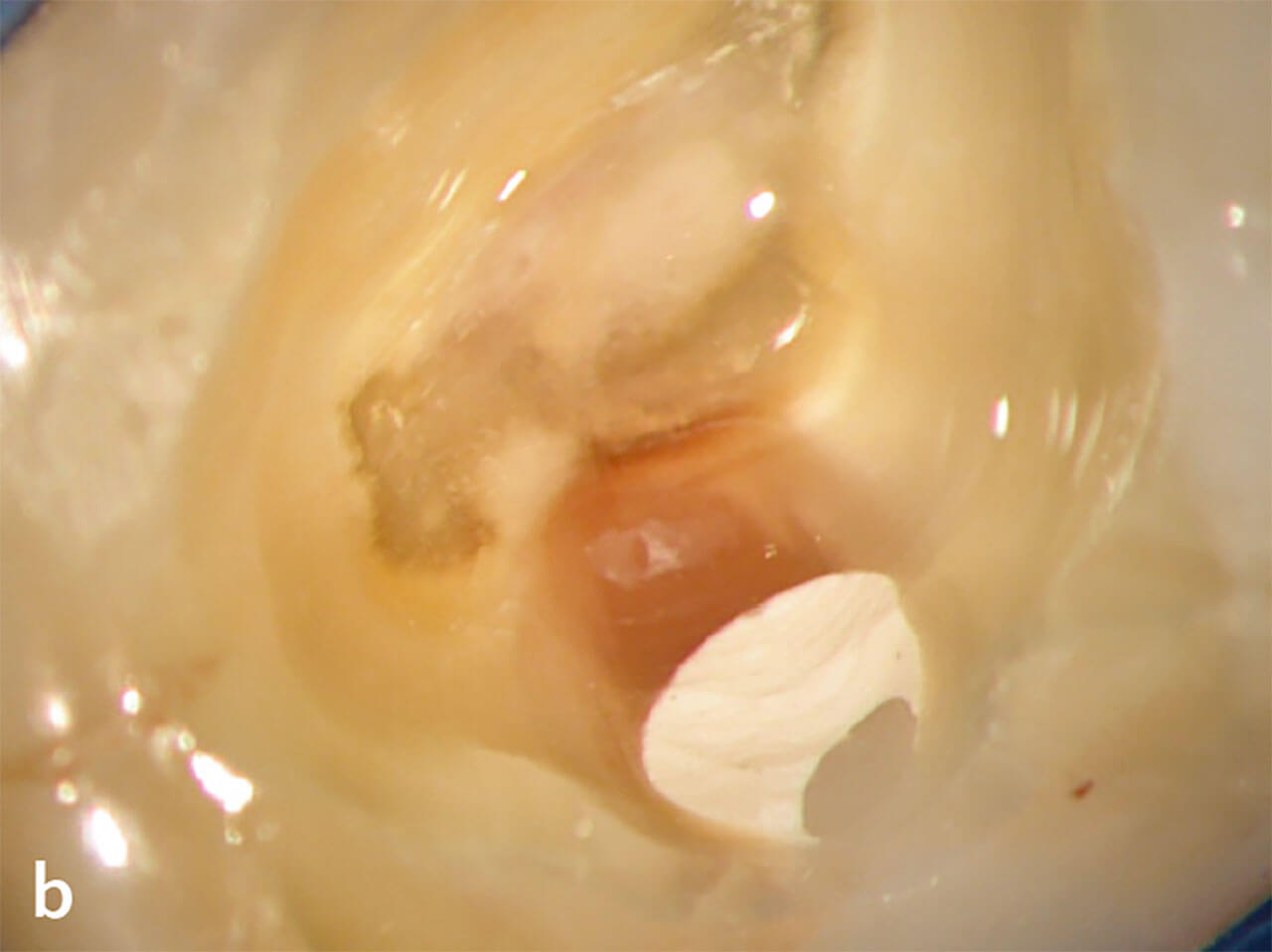 Abb. 1b Nach Entfernung der okklusalen Füllung ließ sich distal kariös verfärbtes Dentin bis zur Pulpakammer erkennen. Eine Unterfüllung und Kompositfüllung verschloss die Kavität ohne unter Vergrößerung erkennbare Randspalten, sodass eine sekundäre Infektion ausgeschlossen werden konnte.