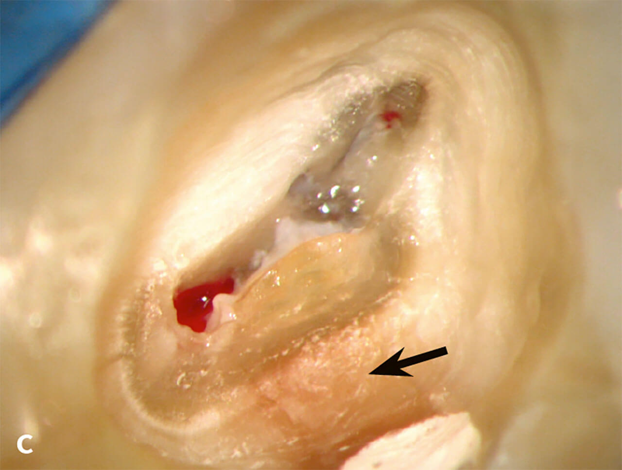 Abb. 1c Nach der Eröffnung des Pulpakammerdachs lag eine Nekrose der Kronenpulpa vor und bestätigte den Verdacht einer irreversiblen Pulpitis nach unvollständiger Kariesentfernung.