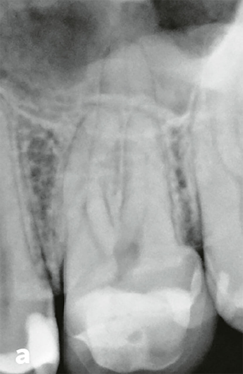 Abb. 2a Zahn 26 einer 34-jährigen Patientin mit pulpiti­schen Beschwerden. Der periapikale radiologische Befund ist unauffällig. Koronal lässt sich eine pulpanahe Füllung vermuten.