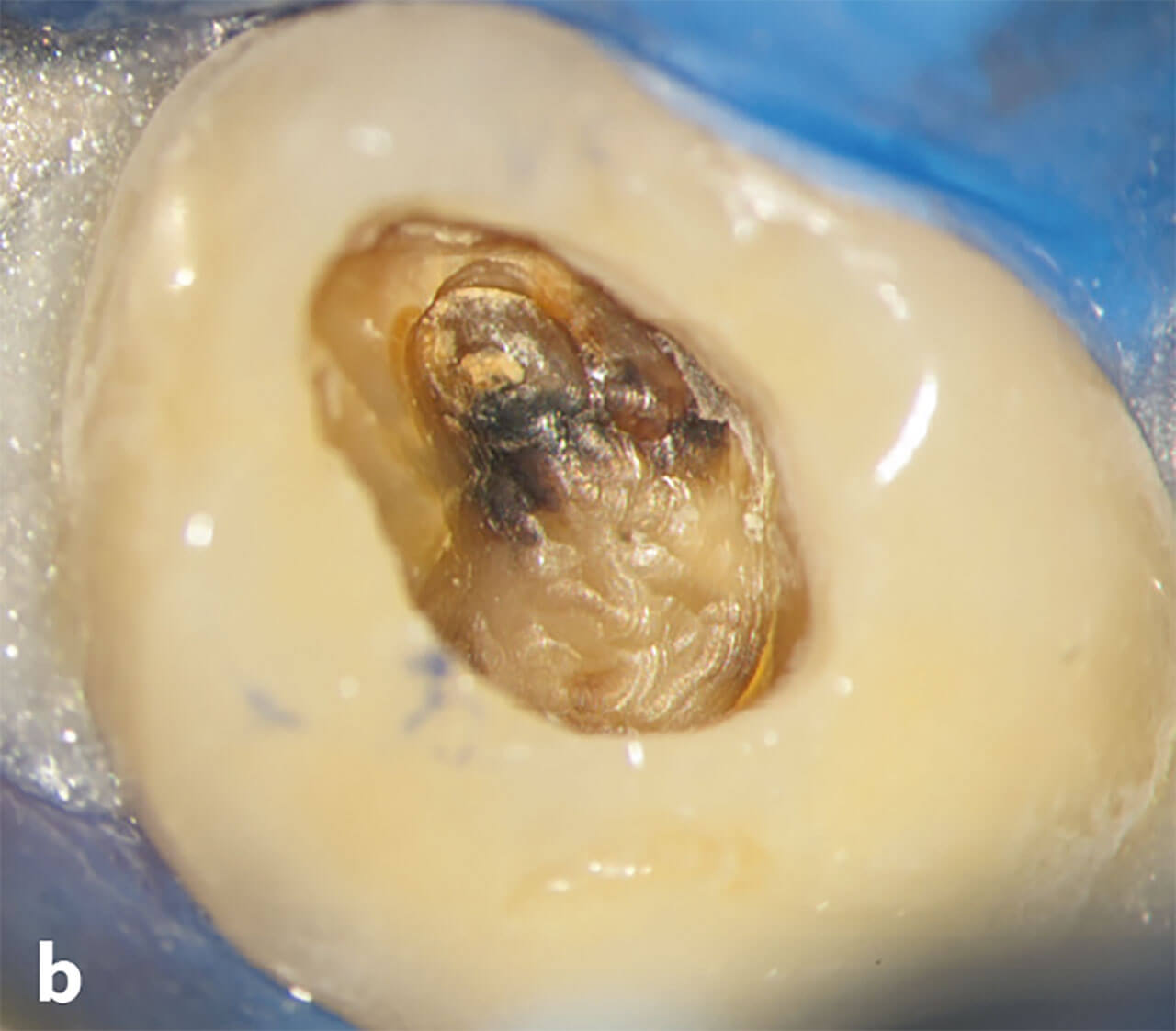 Abb. 2b Während der Freilegung des Kavitätenbodens wird mesiobukkal eine ehemals eröffnete Pulpakammer im kariesfreien Dentin sichtbar. Mineralisiertes Reparaturgewebe hat teilweise zum Verschluss des Pulpakammerdachs beigetragen. Es besteht der Verdacht auf eine partielle Pulpanekrose.