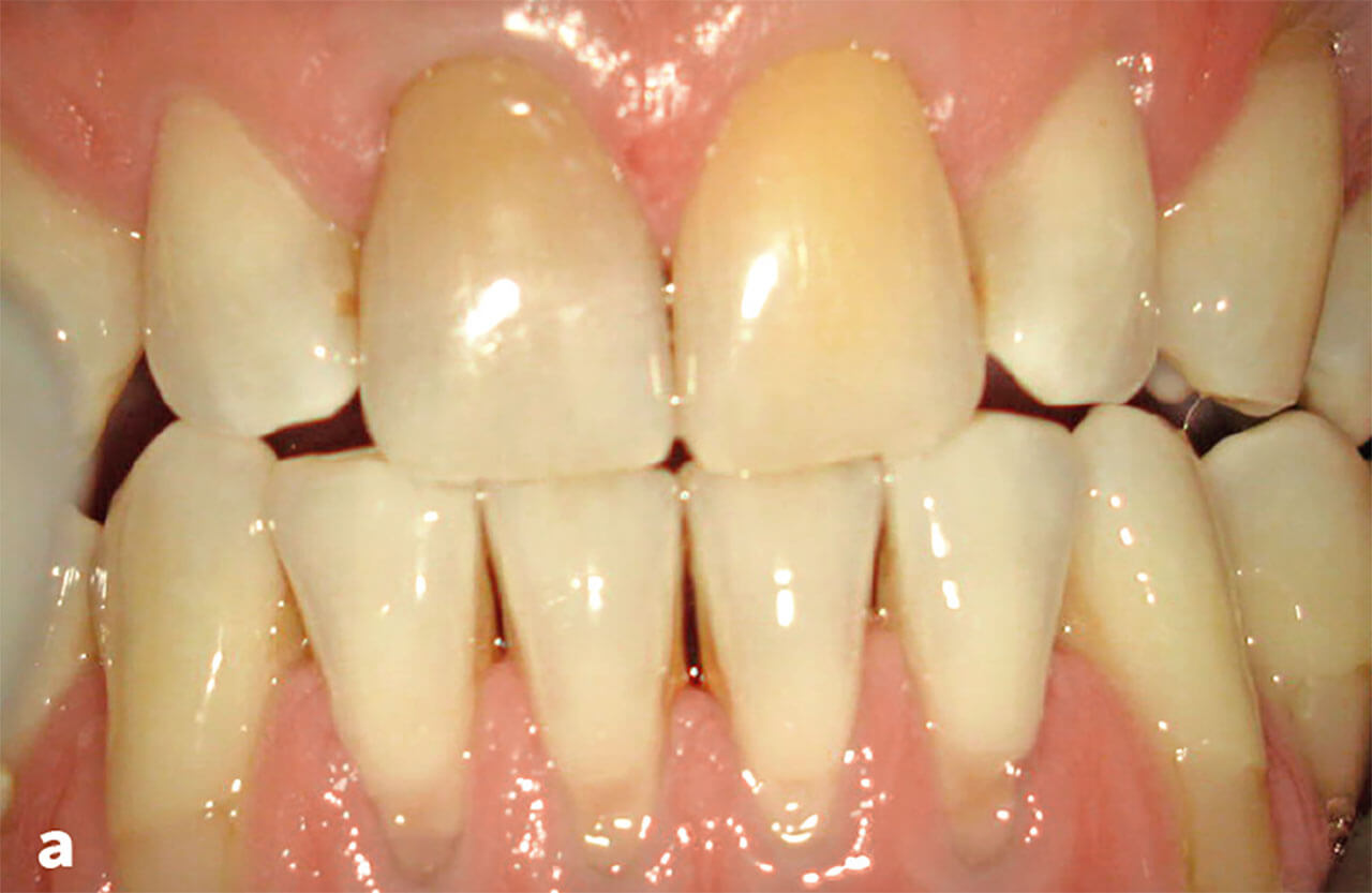 Abb. 3a Die symptomlose Patientin bestätigte ein dentales Trauma und eine zunehmende Verfärbung der Zähne 11 und 21.