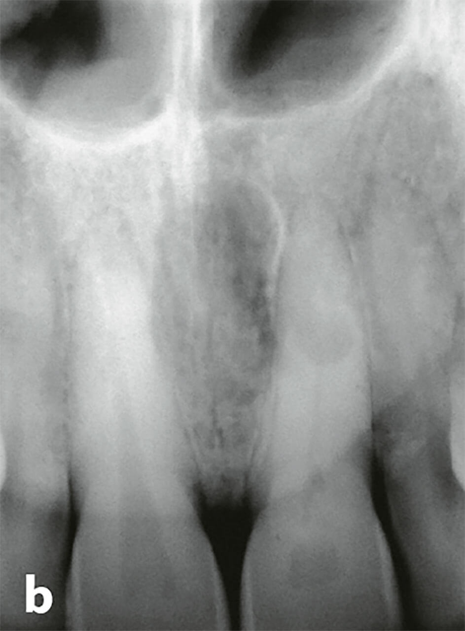Abb. 3b Mit Blick auf die Röntgenaufnahme besteht der Verdacht auf eine interne Resorption. Apikal lag bei beiden Zähnen kein pathologischer Befund vor.