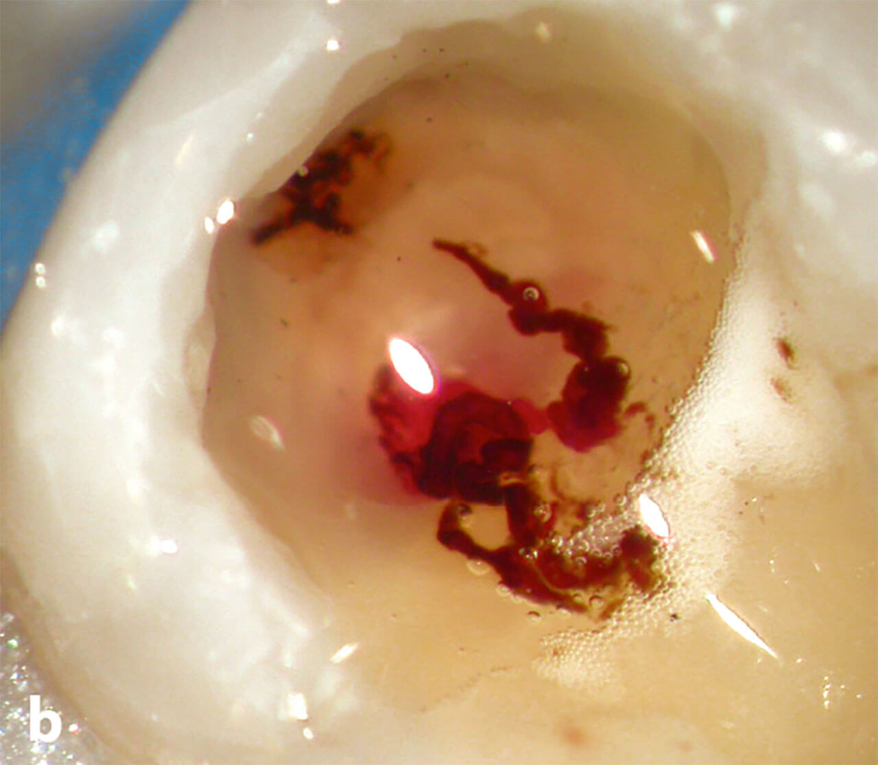 Abb. 4b Nach einer Aufbaufüllung mit Komposit wurde das kariöse Dentin vollständig entfernt und die eröffnete Pulpa partiell angefrischt mit einem kugelförmigen Diamanten unter Wasserkühlung.