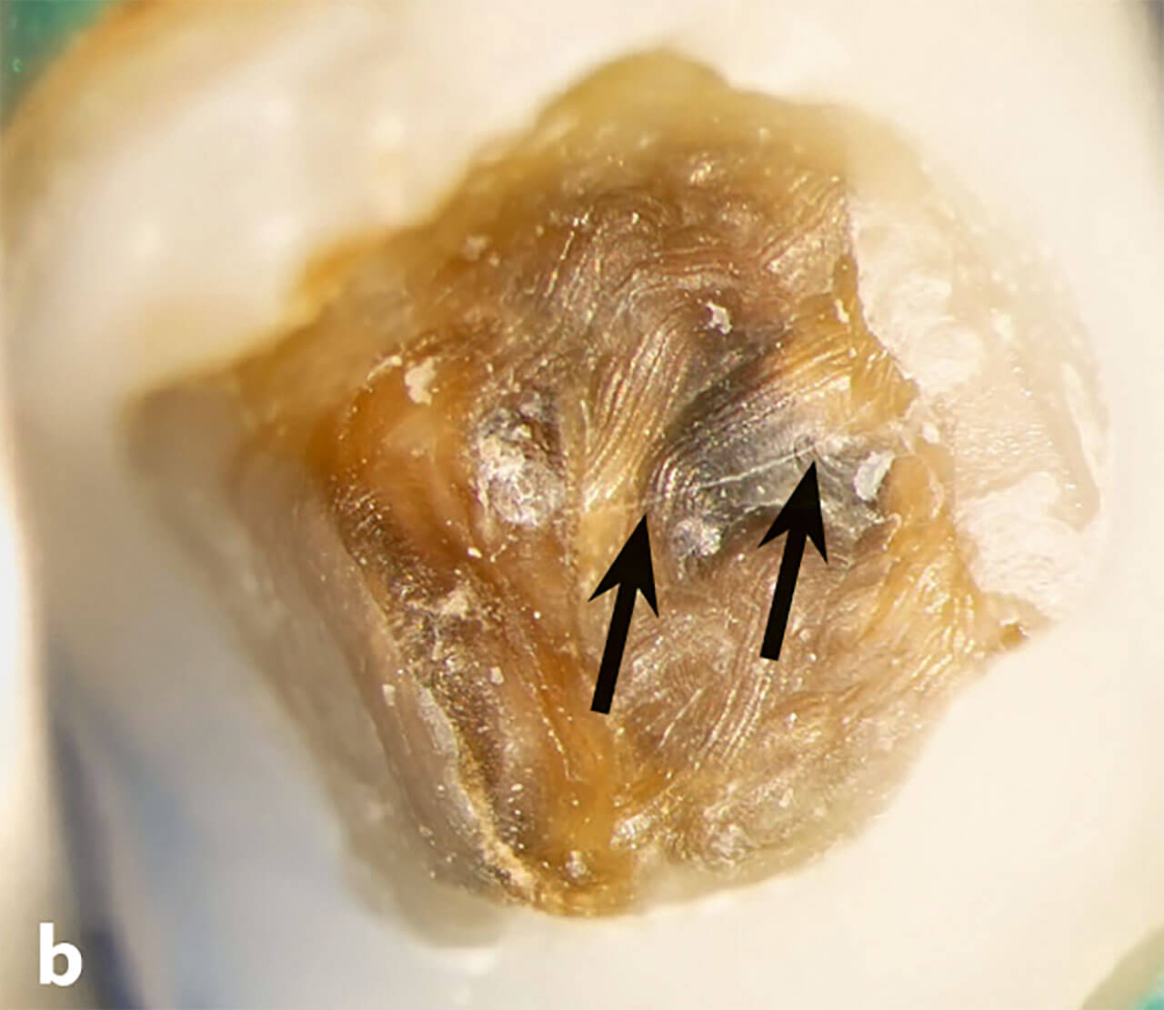 Abb. 5b Das Dentin am Kavitätenboden war bräunlich verfärbt. Von mesial nach distal ließ sich ein Dentinriss erkennen mit einer Ausdehnung bis zur Pulpakammer (Pfeile). 