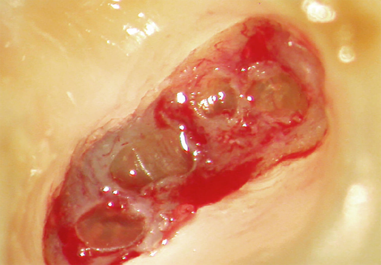 Abb. 8 Mehrere bernsteinfarbene Pulpasteine innerhalb der Kronenpulpa des Zahns 17.