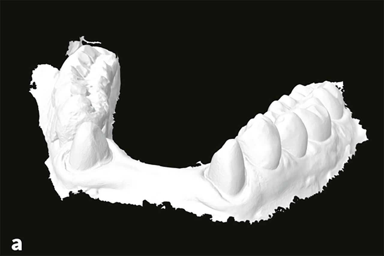 Abb. 8a bis c Digital gescannter STL-Datensatz der präparierten Pfeiler.
