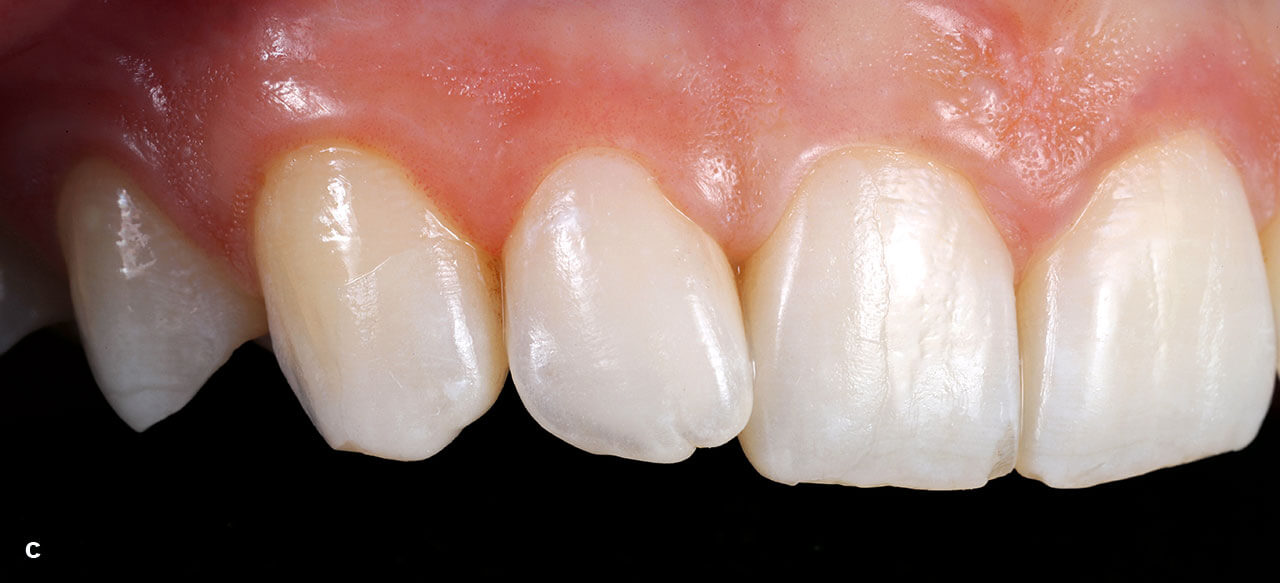 Abb. 1a bis c Einprobe der partiellen Veneers an den Zähnen 11, 12 und 13 mit „Try-in“-Pasten (Farbe neutral; c).