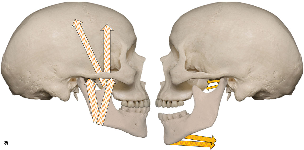 Abb. 4a Adduktoren (links, weiß): Bei bilateraler Aktivität der Pars anterior und medialis des M. temporalis, dem profunden und superficialen Anteil des M. masseter und des M. pterygoideus medialis wird der Kieferschluss erreicht. Abduktoren (rechts, gelb): Der M. pterygoideus lateralis und die suprahyoidale Muskulatur erreichen bei bilateraler Aktivität die Kieferöffnung 