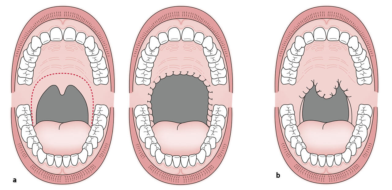 Das Bild zeigt drei schematische Zeichnungen des weit geöffneten Munds mit Blick auf den weichen Gaumen. Links die Ausgangssituation und die schematische Darstellung des im Bogen ohne Erhalt des Zäpfchens entfernten Gaumengewebes (1a), rechts die Operationstechnik, bei der Weichgewebe entfernt und das Zäpfchen rekonstruiert wird.