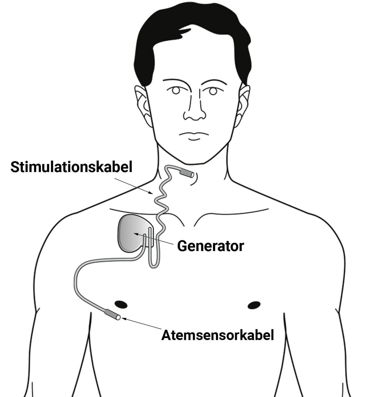 Schematische Zeichnung eines männlichen Oberkörpers und Kopfes. Eingezeichnet ist ein flacher Generator, der etwa rechts am Schlüsselbein liegt. Von dort gehen ein Atemsensorkabel etwa auf die Höhe der Brustwarze und ein Stimulationskabel zum Zungengrundbereich ab.