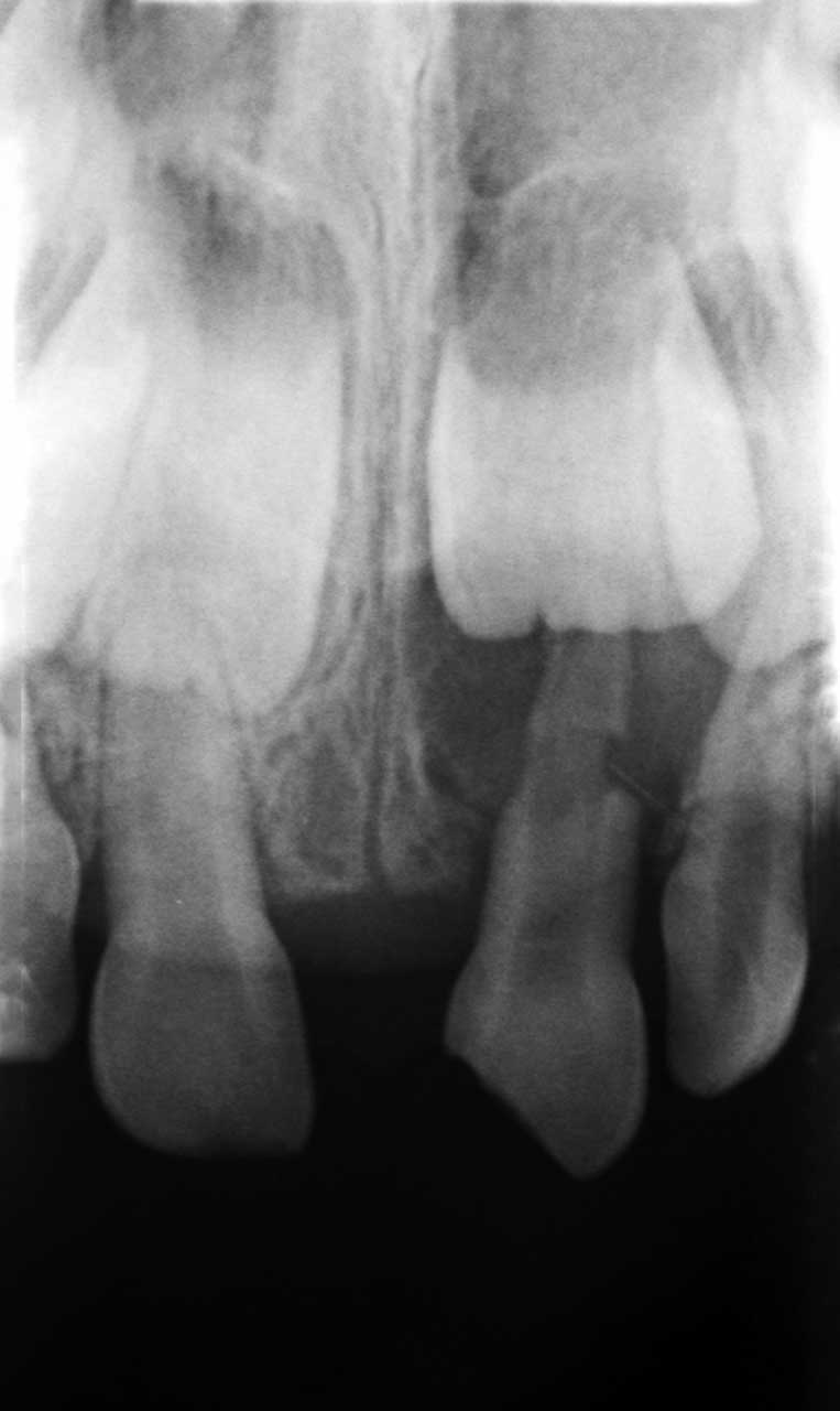 Abb. 4 Ausgedehnte apikale Aufhellung sowie infektionsbedingte Resorption an Zahn 61 nach Dislokation und Schmelz-Dentin-Fraktur.