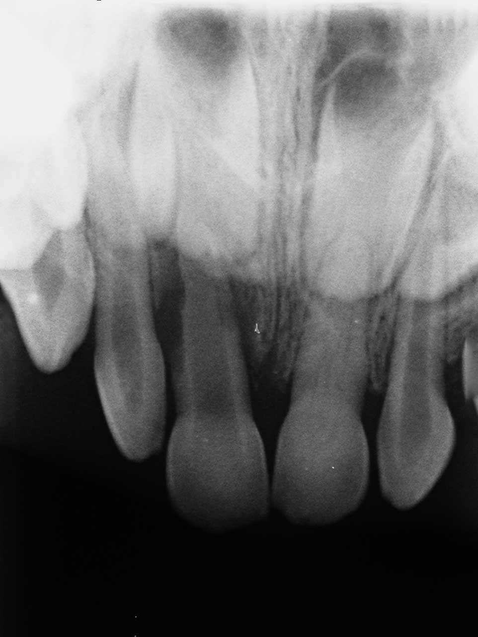 Abb. 9 Infektionsbedingte Wurzelresorption an Zahn 51 (Verlust von Dentin, Wurzel­zement und umgebenden Knochen) sowie vollständige unfallbedingte Obliteration des Zahns 61.